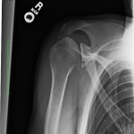LBShoulder