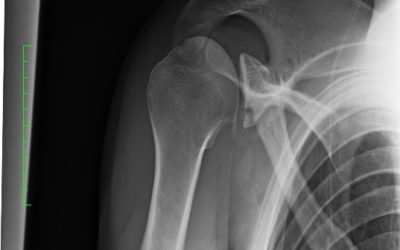How Do You Treat a Shoulder Fracture?